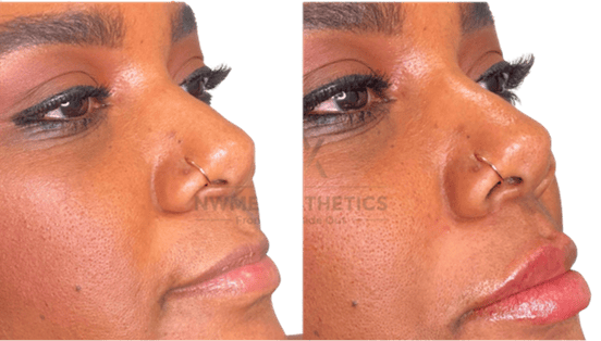Dermal Fillers Before & After Images | NWME Aesthetics | Carrollton, TX