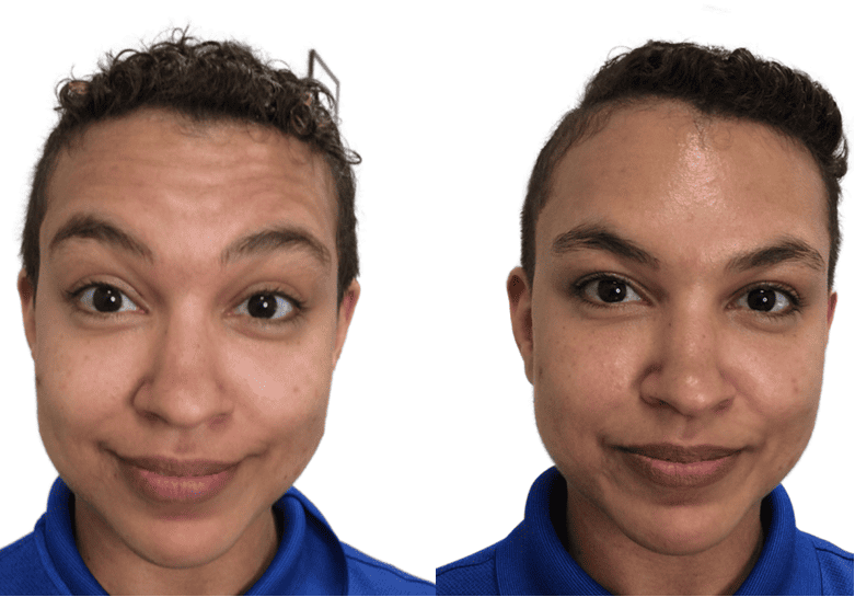Wrinkle Relaxers Before & After Images | NWME Aesthetics | Carrollton, TX