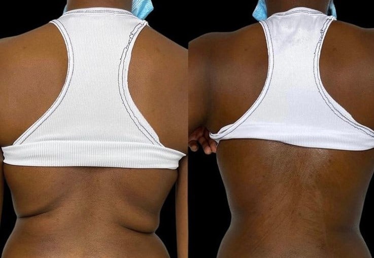 Beofre and After Images | NWME Aesthetics | Carrollton, TX