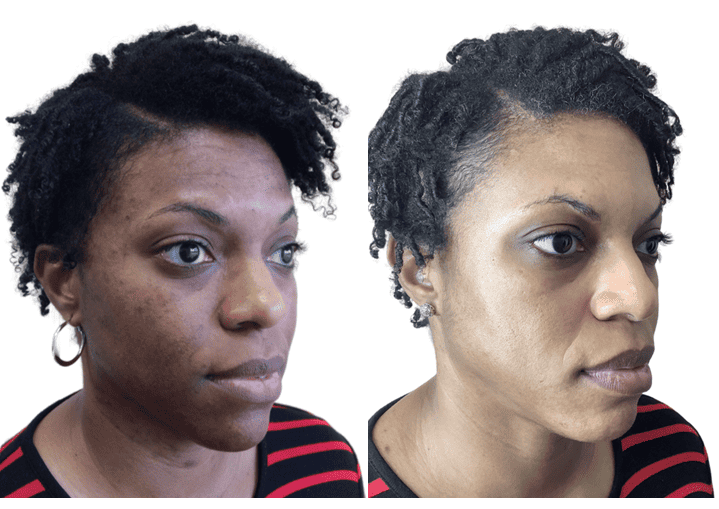 Before and After images | NWME Aesthetics | Carrollton, TX