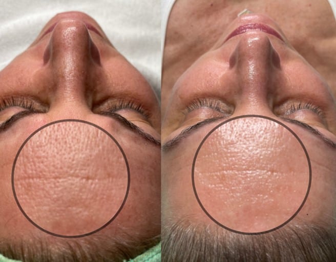 Hydroglow Facials | Before and After images in NWME Aesthetics