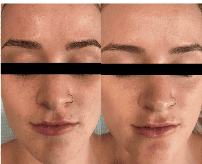 Before and After images | NWME Aesthetics | Carrollton, TX