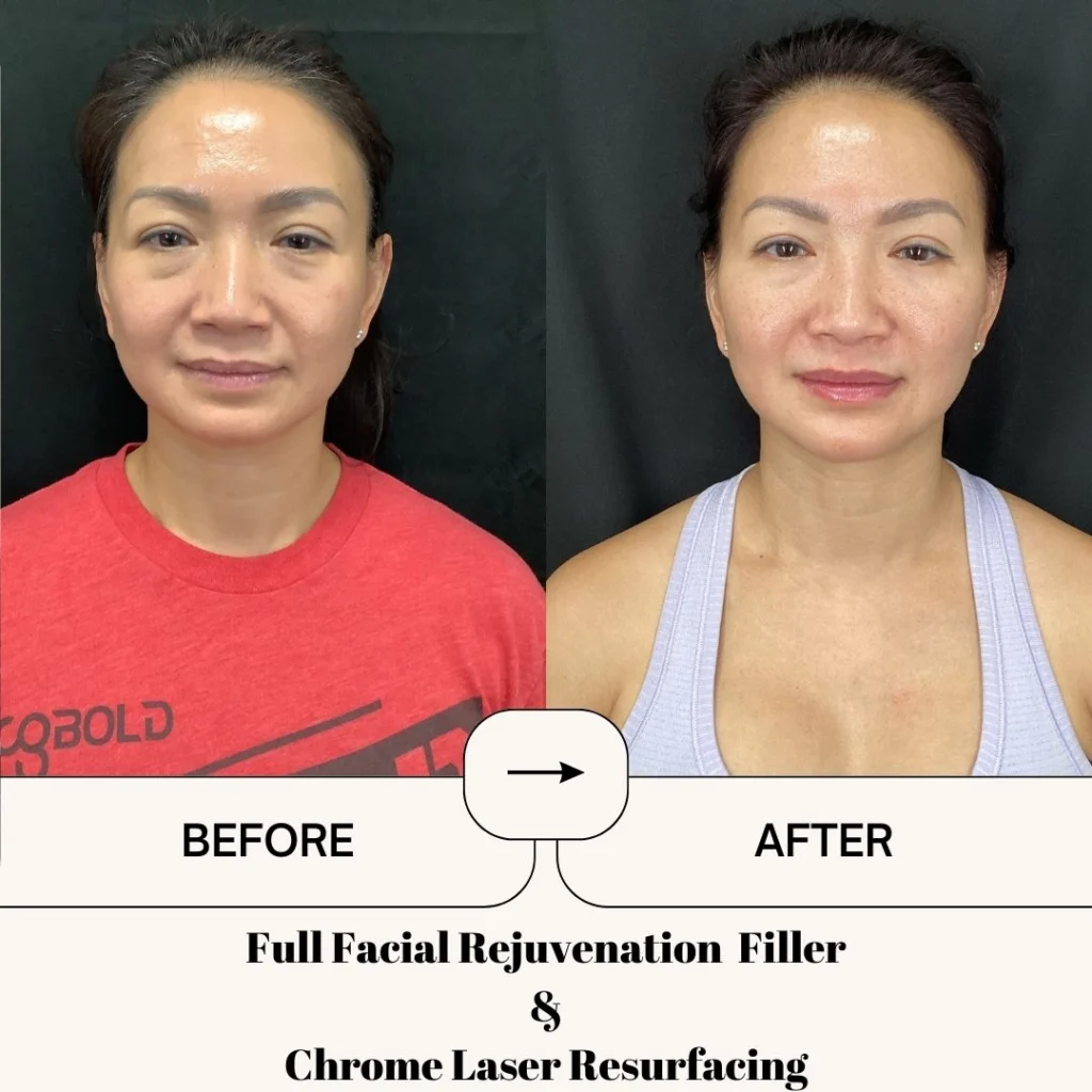 Full Facial Rejuvenation Filler