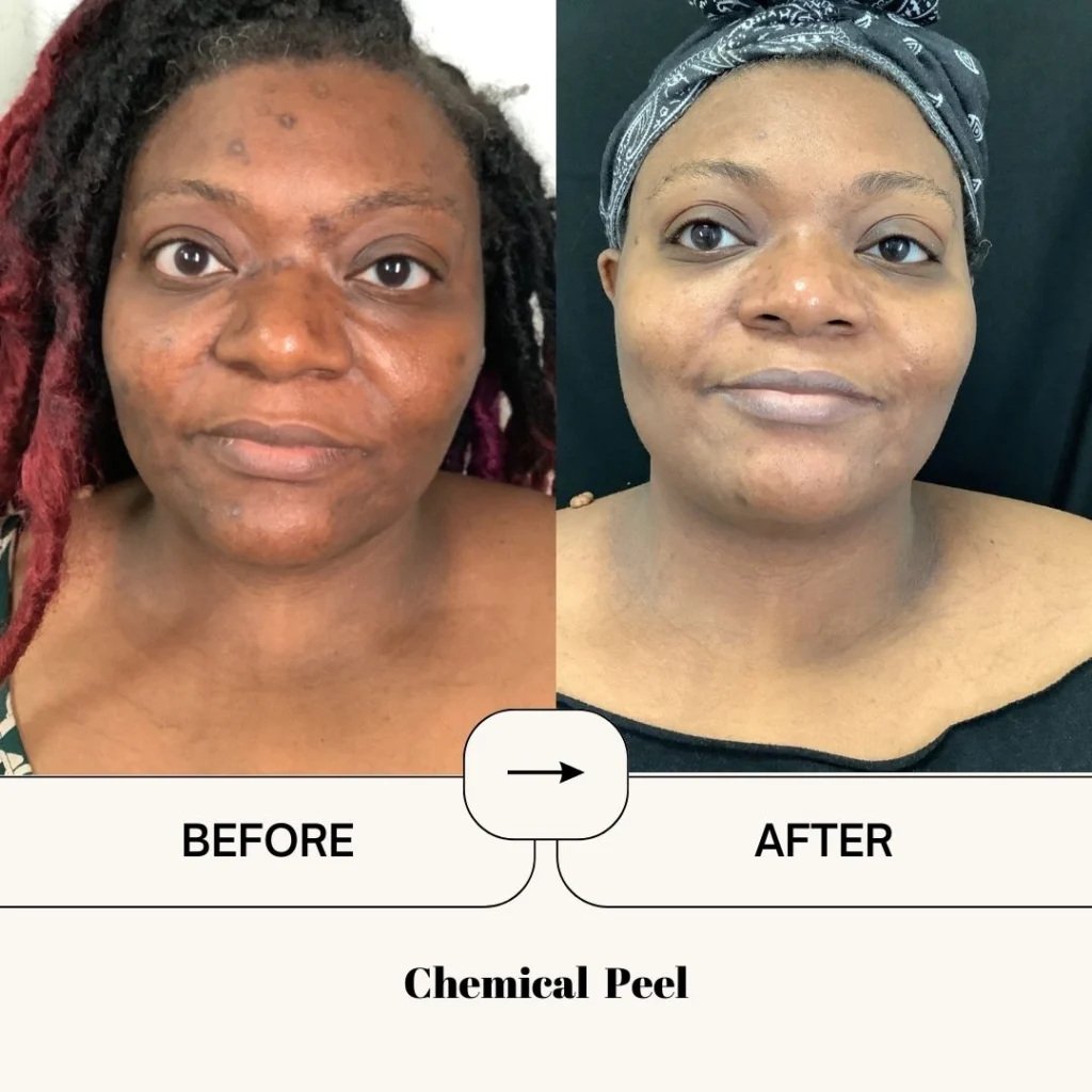 chemical peel