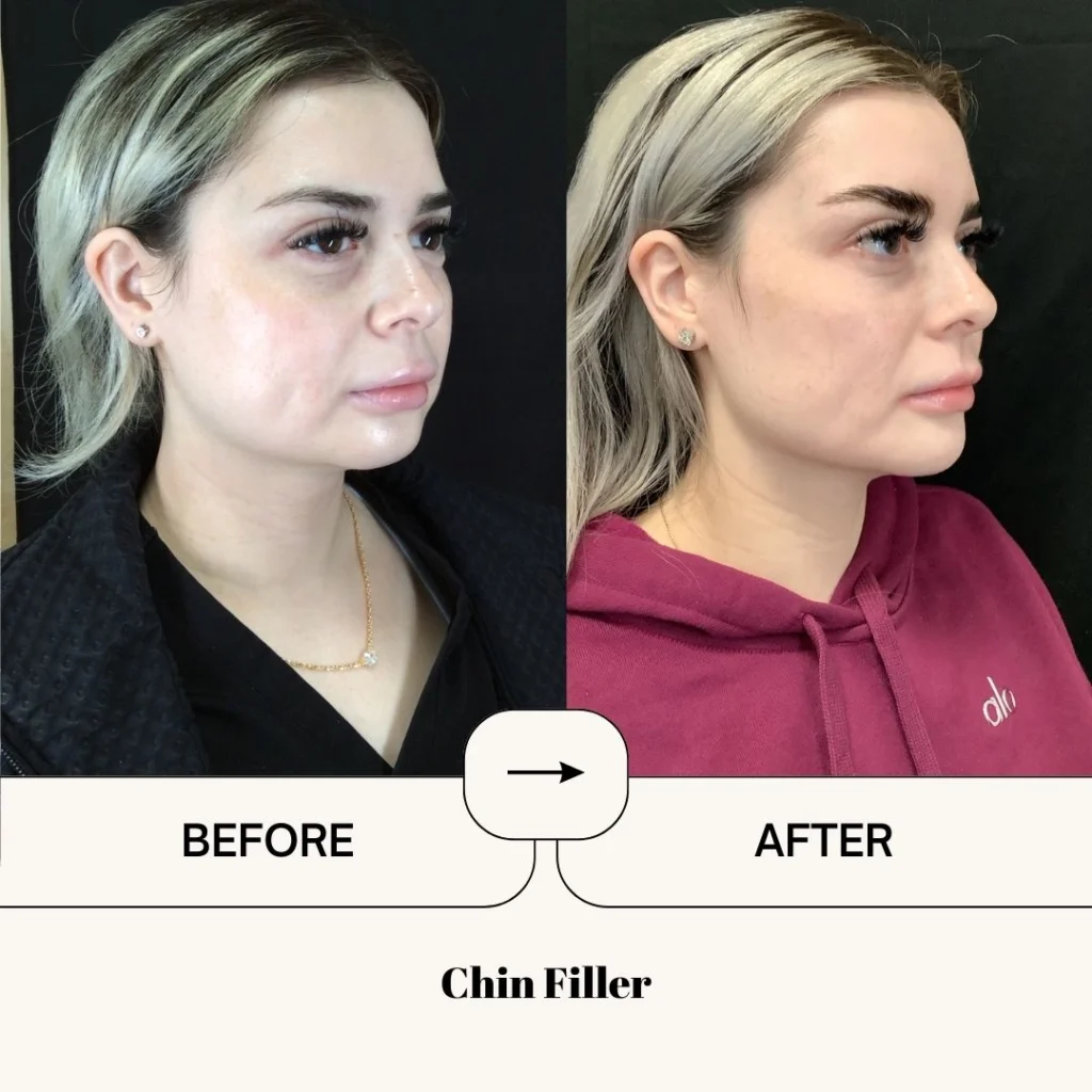 chin filler