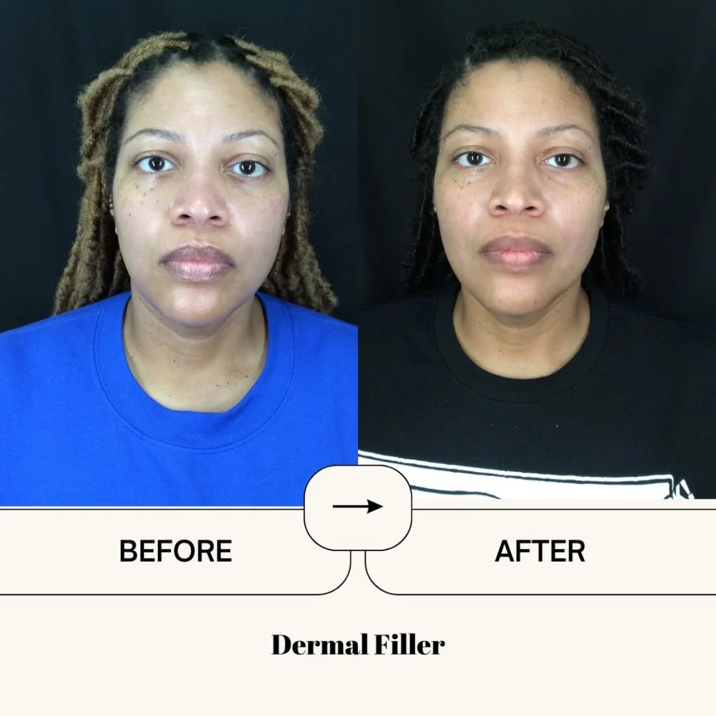 dermal filler