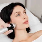 RF Microneedling by NWME Aesthetics in Carrollton, TX