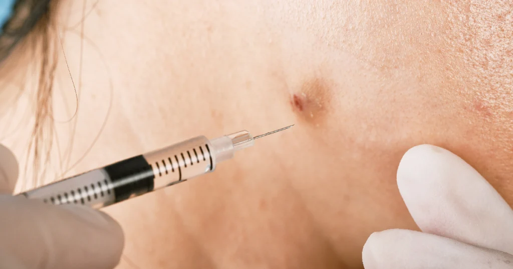 Close up of cortisone injection into inflamed skin by gloved professional in Carrollton TX 1