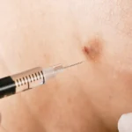 Close-up of cortisone injection into inflamed skin by gloved professional in Carrollton, TX