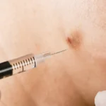 Close-up of cortisone injection into inflamed skin by gloved professional in Carrollton, TX