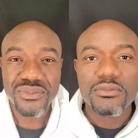 NWMEFacialBalancingB&A-a-a-nwme-aesthetics