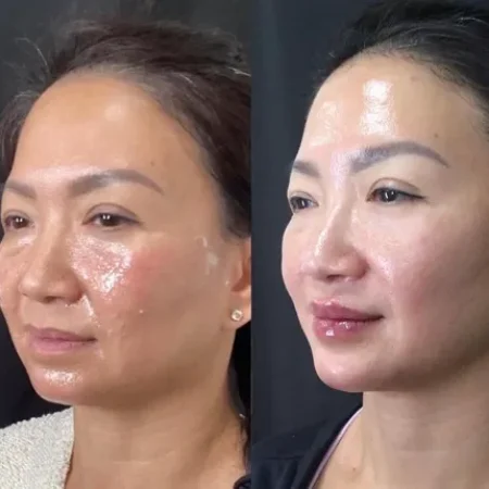 NWMEFacialBalancingB&A-c-a-nwme-aesthetics