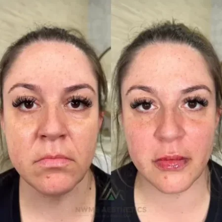 NWMEFacialBalancingB&A-d-a-nwme-aesthetics