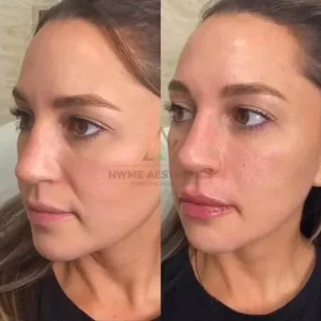 NWMEFacialBalancingB&A-e-a-nwme-aesthetics