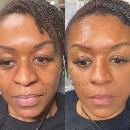NWMEFacialBalancingB&A-g-a-nwme-aesthetics