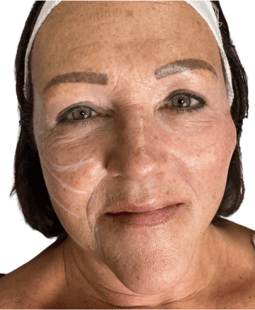 PDO Thread Lift 1 PDO Thread Lift | NWME Aesthetics | Carrollton, TX