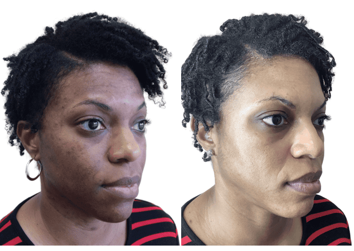 Chemical Peels Before & After Images | NWME Aesthetics | Carrollton, TX