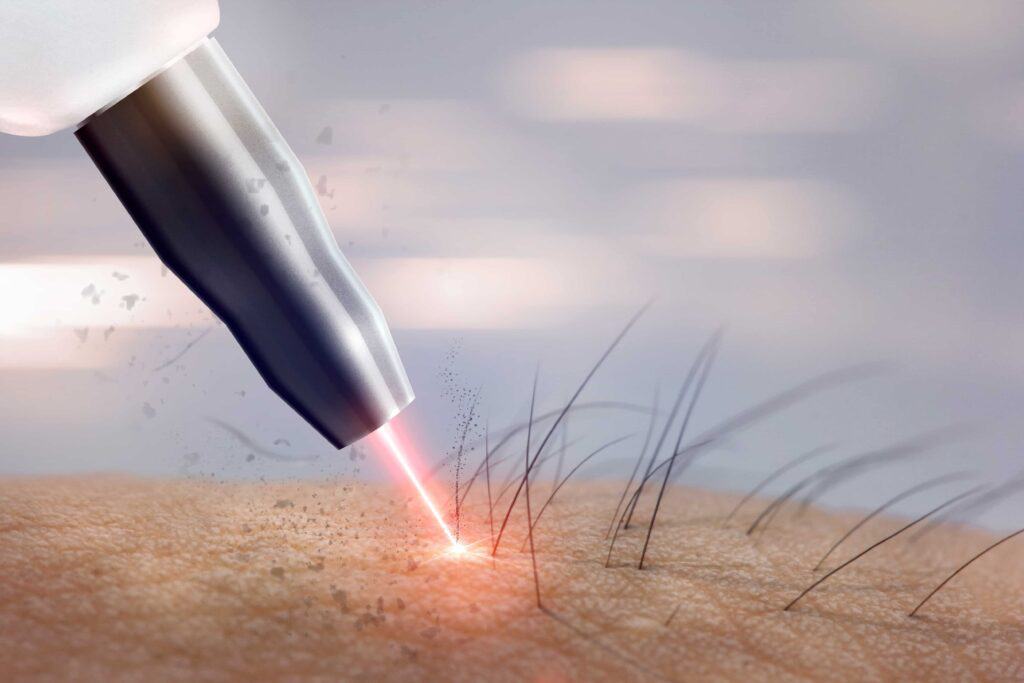 Laser Hair Removal | NWME Aesthetics | Carrollton, TX