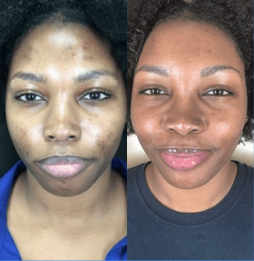Express Facial | Before and After images in NWME Aesthetics