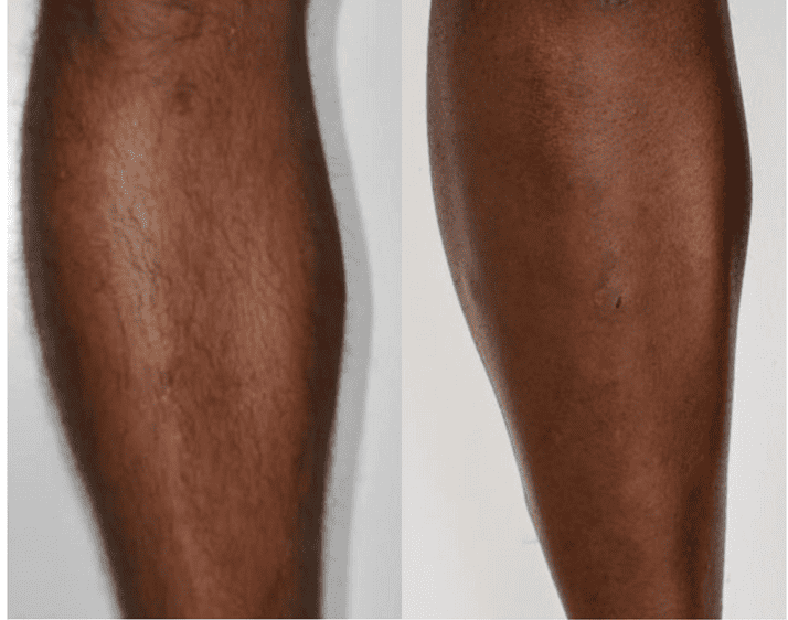 Laser Hair Removal | Before and After Images | NWME Aesthetics | Carrollton, TX