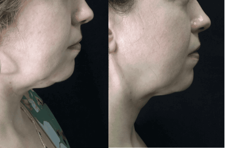 Kybella Treatments | Before and After Images | NWME Aesthetics | Carrollton, TX