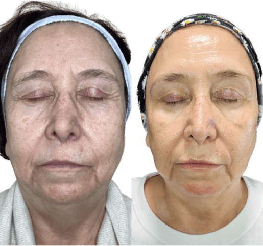 Before and After images | NWME Aesthetics | Carrollton, TX